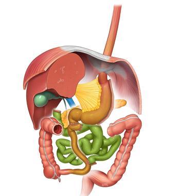 Duodenal Switch